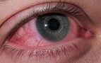 Infección ocular