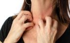 dermatitis atópica