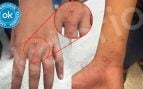 Primer caso de viruela del mono en Ceuta: un mena marroquí de 17 años aislado en un centro para menores