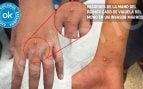 Primer caso de viruela del mono en Ceuta: un mena marroquí de 17 años aislado en un centro para menores