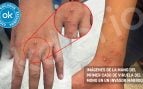 Primer caso de viruela del mono en Ceuta: un mena marroquí de 17 años aislado en un centro para menores