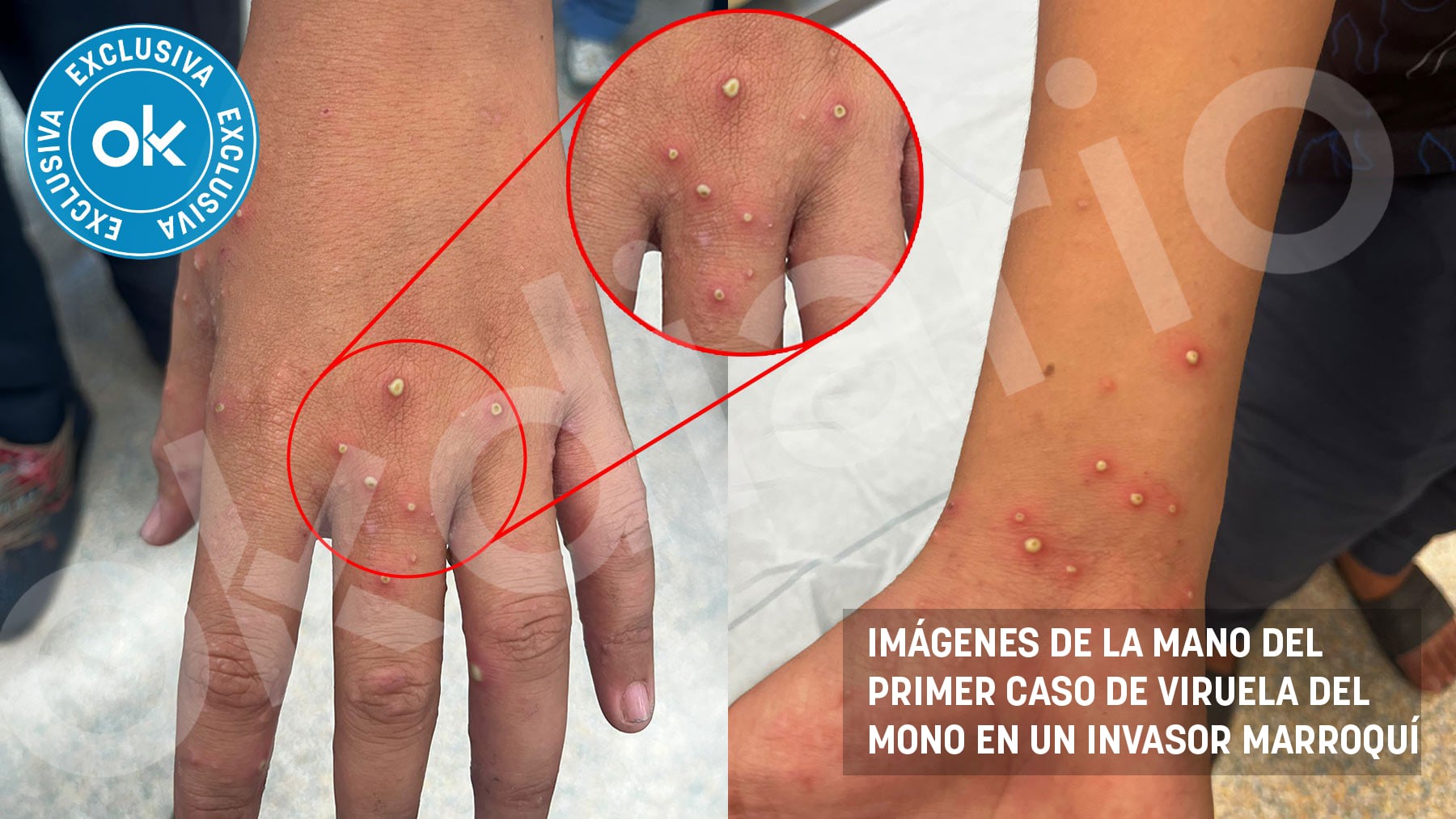 Primer caso de viruela del mono en Ceuta: un mena marroquí de 17 años aislado en un centro para menores
