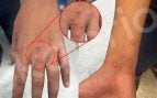 Primer caso de viruela del mono en Ceuta: un mena marroquí de 17 años aislado en un centro para menores