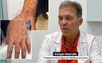 El presidente de los médicos de Ceuta alerta: «Donde hay un caso de virus de viruela del mono es porque hay más»