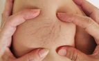 Escleroterapia con microespuma: la técnica sin cirugía ni anestesia para eliminar las varices en consulta