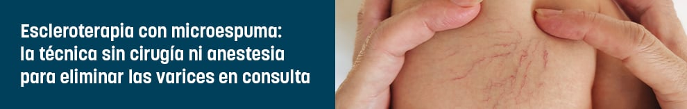 Escleroterapia con microespuma: la técnica sin cirugía ni anestesia para eliminar las varices en consulta