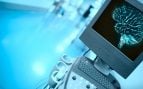 ¿Qué es la radiocirugía sin incisiones y cómo puede ayudar frente a la depresión resistente?