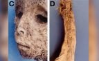 La erupción vesiculopustular que originalmente se diagnosticó como viruela, visible en el rostro (izquierda) y el brazo (derecha) de la momia infantil de Nápoles. Foto: Patterson Ross et al. - PLOS Pathogens, CC BY 4.0