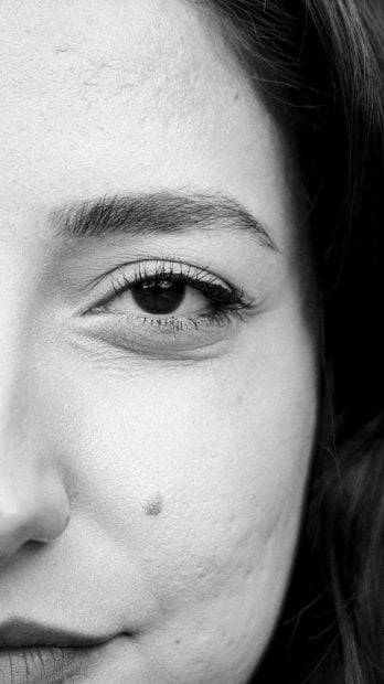 blefaroplastia cirugía estética