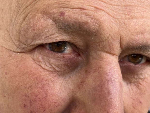 blefaroplastia cirugía estética