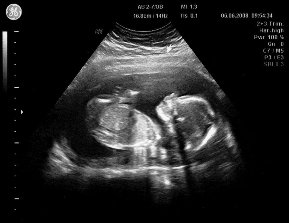 Las ecografías durante el embarazo. Todo lo que hay que saber