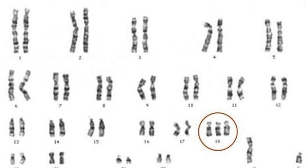 Resultado de imagen para sindrome de edwards