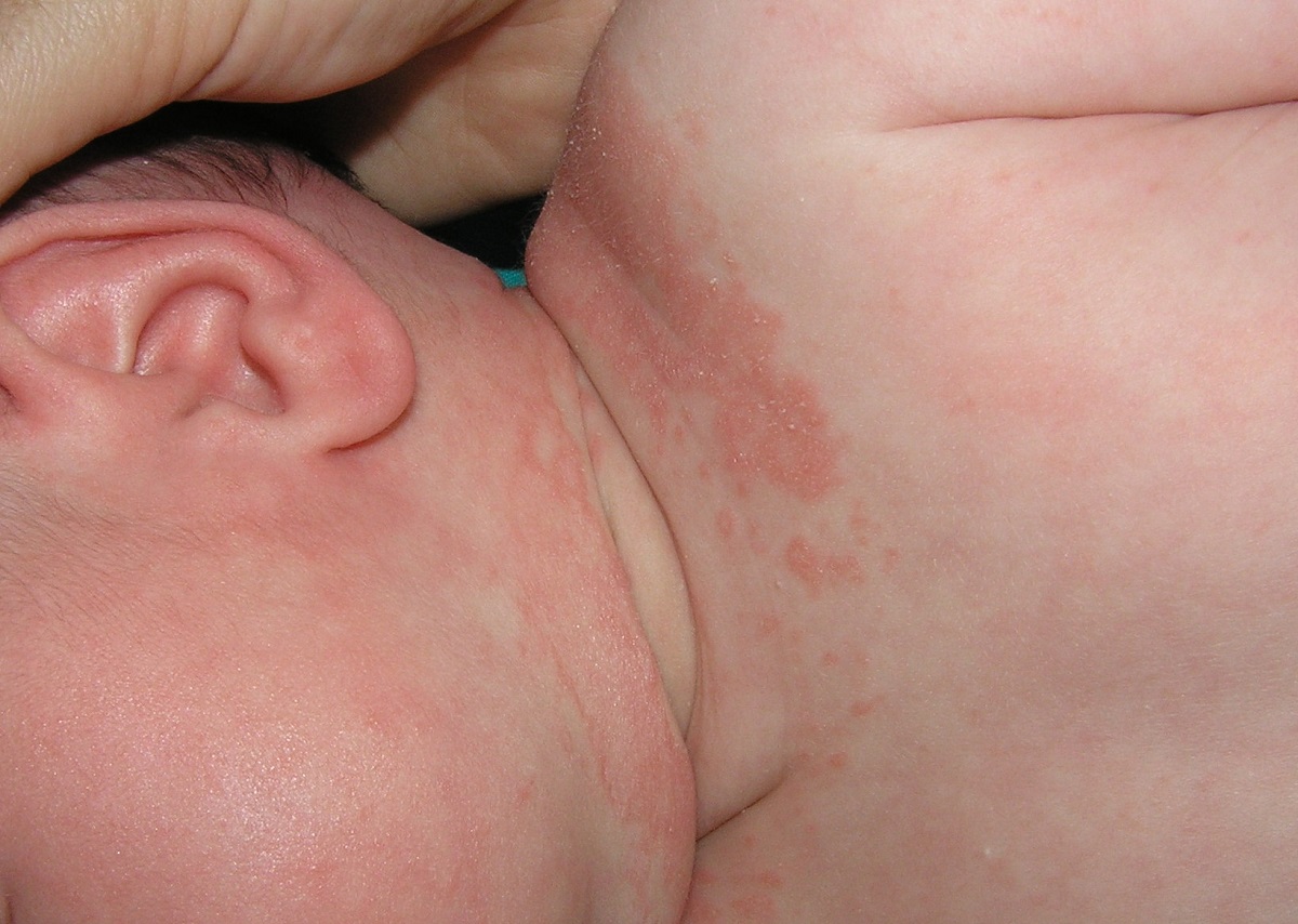 sintomas de piel atopica en niños