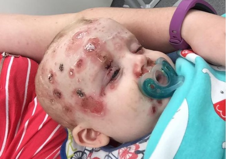 Impactantes imágenes de un bebé con varicela