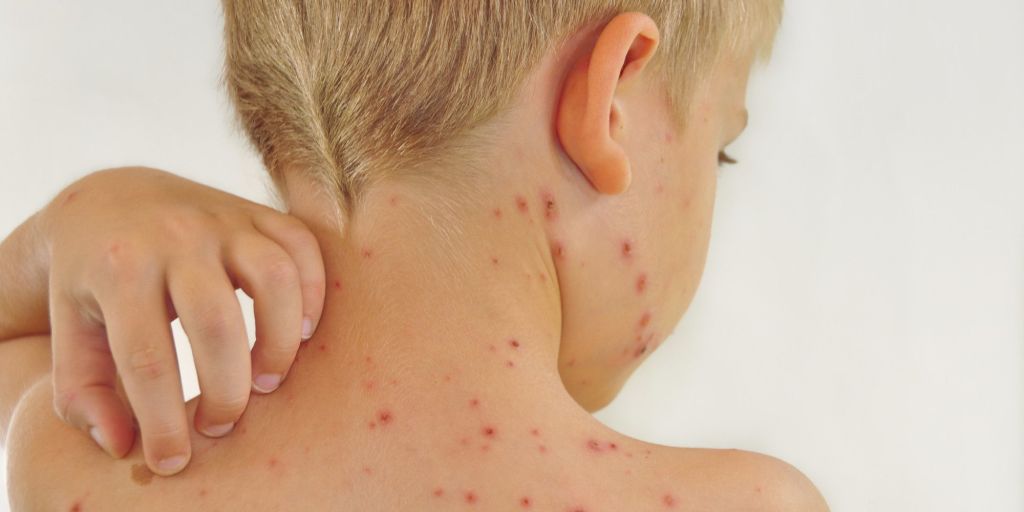 La varicela en niños. Todo lo que necesitas saber