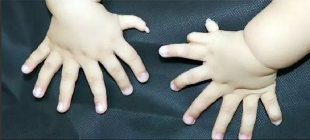 Viral: el bebé que cuenta ¡con más de 30 dedos!