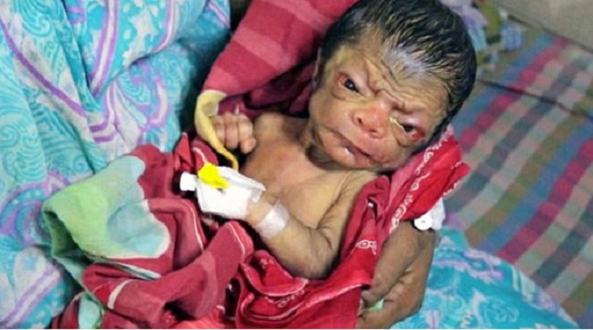 Viral: nace un bebé con la enfermedad de Benjamin Button