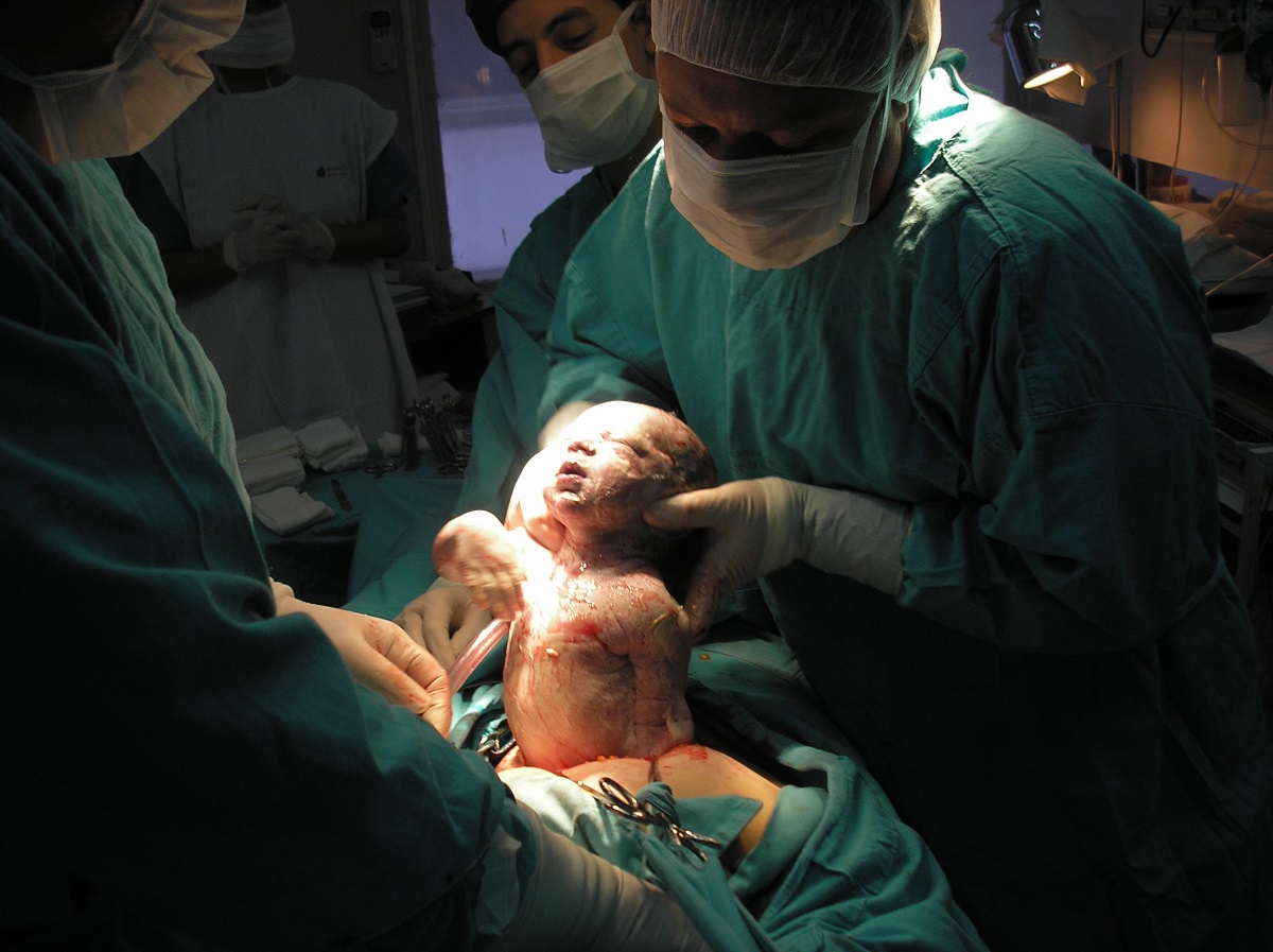 La cesárea, un parto que, según un estudio, altera la evolución humana