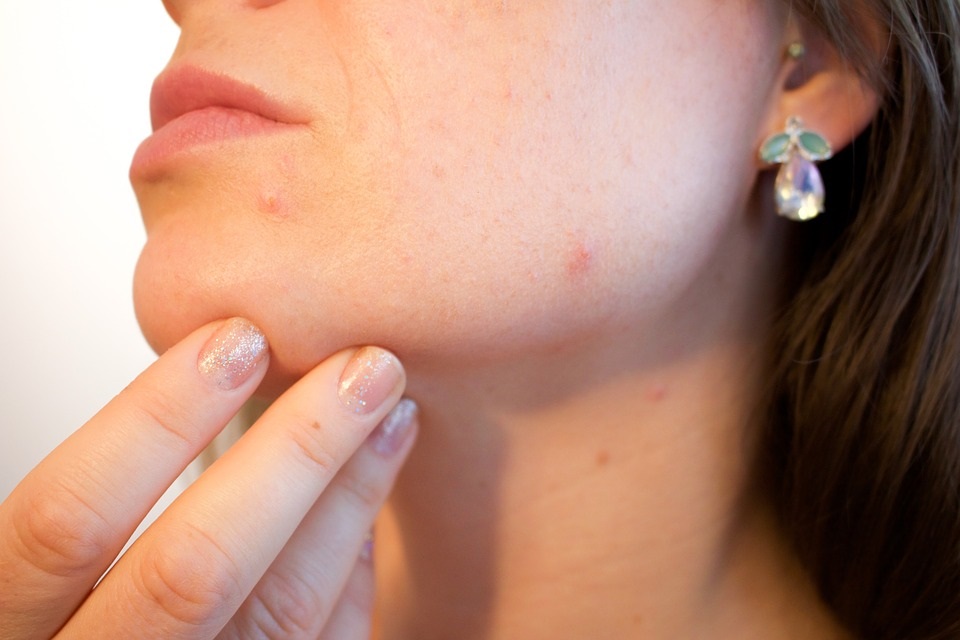 Acne en el embarazo es nina