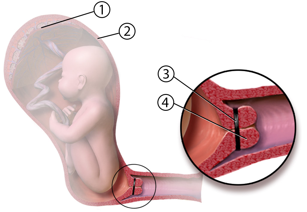 Cerclaje cervical en el embarazo. ¿Qué es?