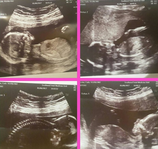 Viral. Embarazada de ¡dos pares de gemelas!