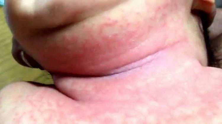 ronchas grandes en la piel de un bebe ronchas grandes en la piel de un bebe