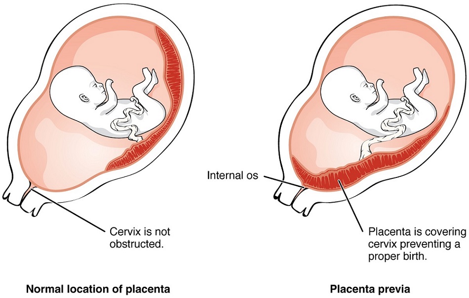 Placenta previa: Síntomas, tipos y riesgos de la placenta ...