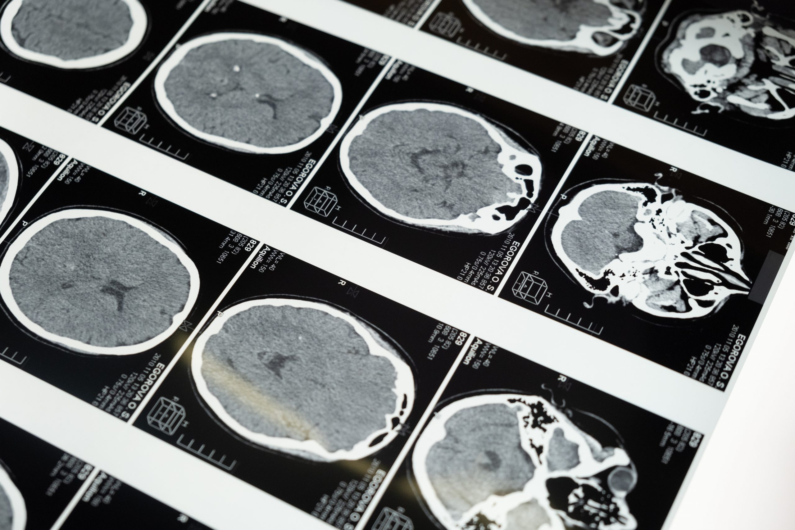 Radiograf&iacute;a del cerebro