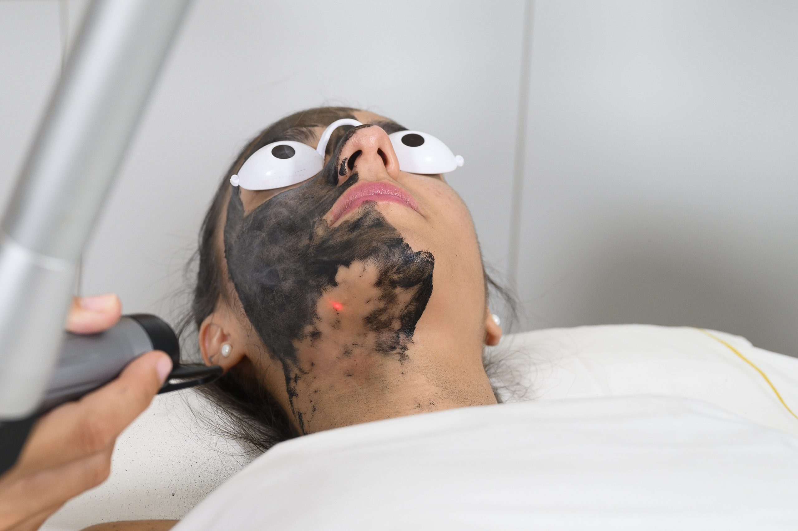 Foto: Tratamiento Carbon&nbsp;Peel de MY