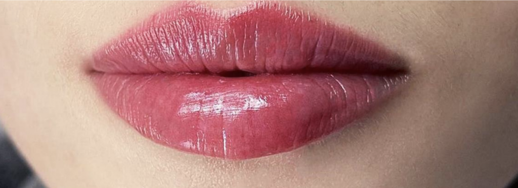 Labio infiltrado con la t&eacute;cnica de labios rusos