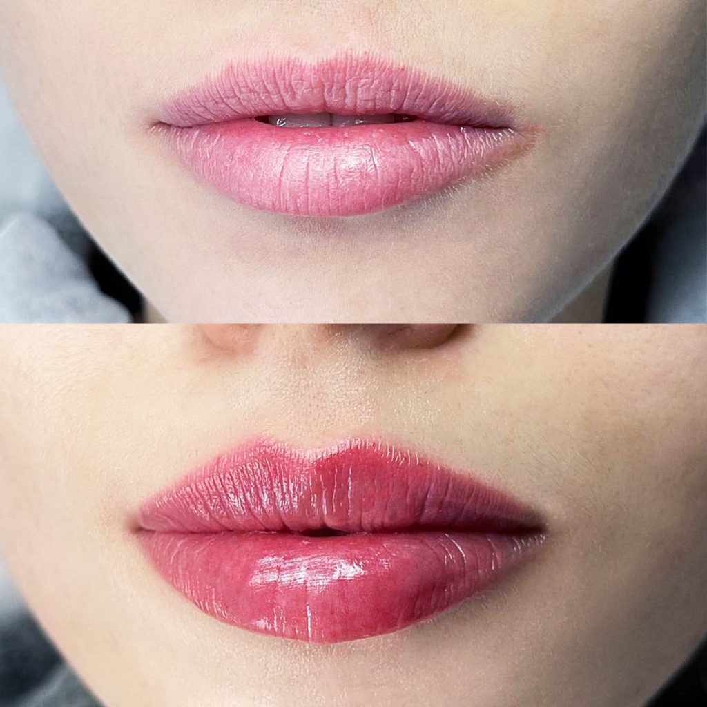 Antes y despu&eacute;s de labios rusos en AC DermaStudio