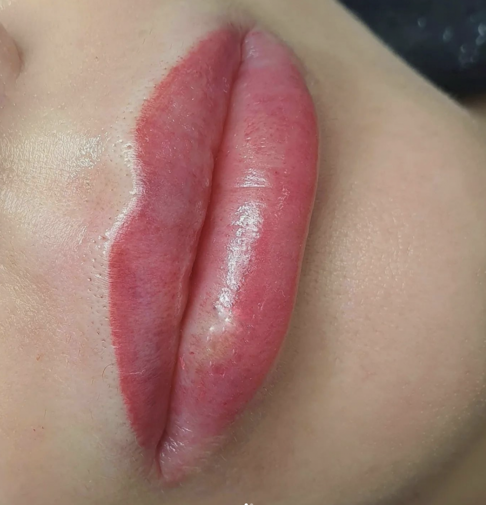 T&eacute;cnica de labios rusos en AC DermaStudio