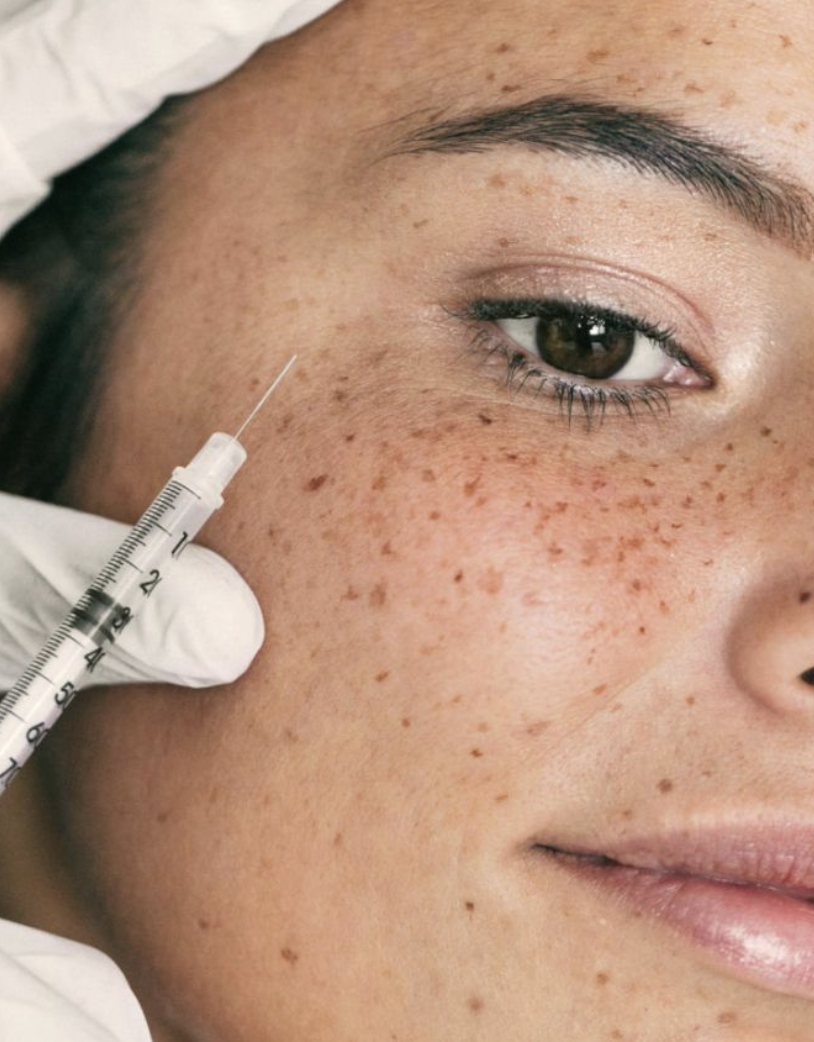 Tratamientos contra las ojeras