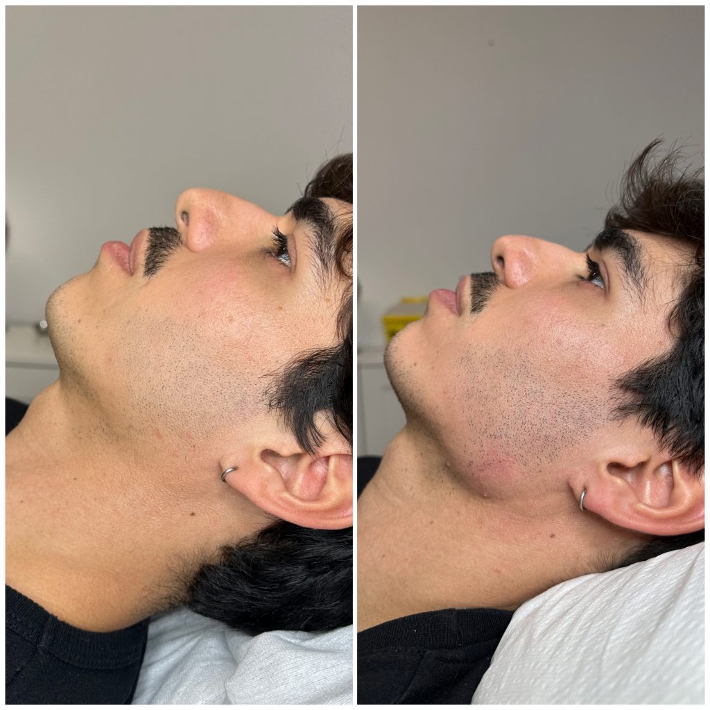 Antes y despu&eacute;s del russian contouring en AC DermaStudio