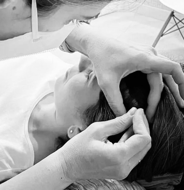 Acupuntura facial