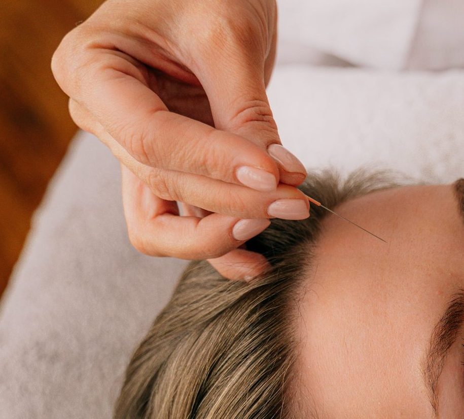 Acupuntura facial