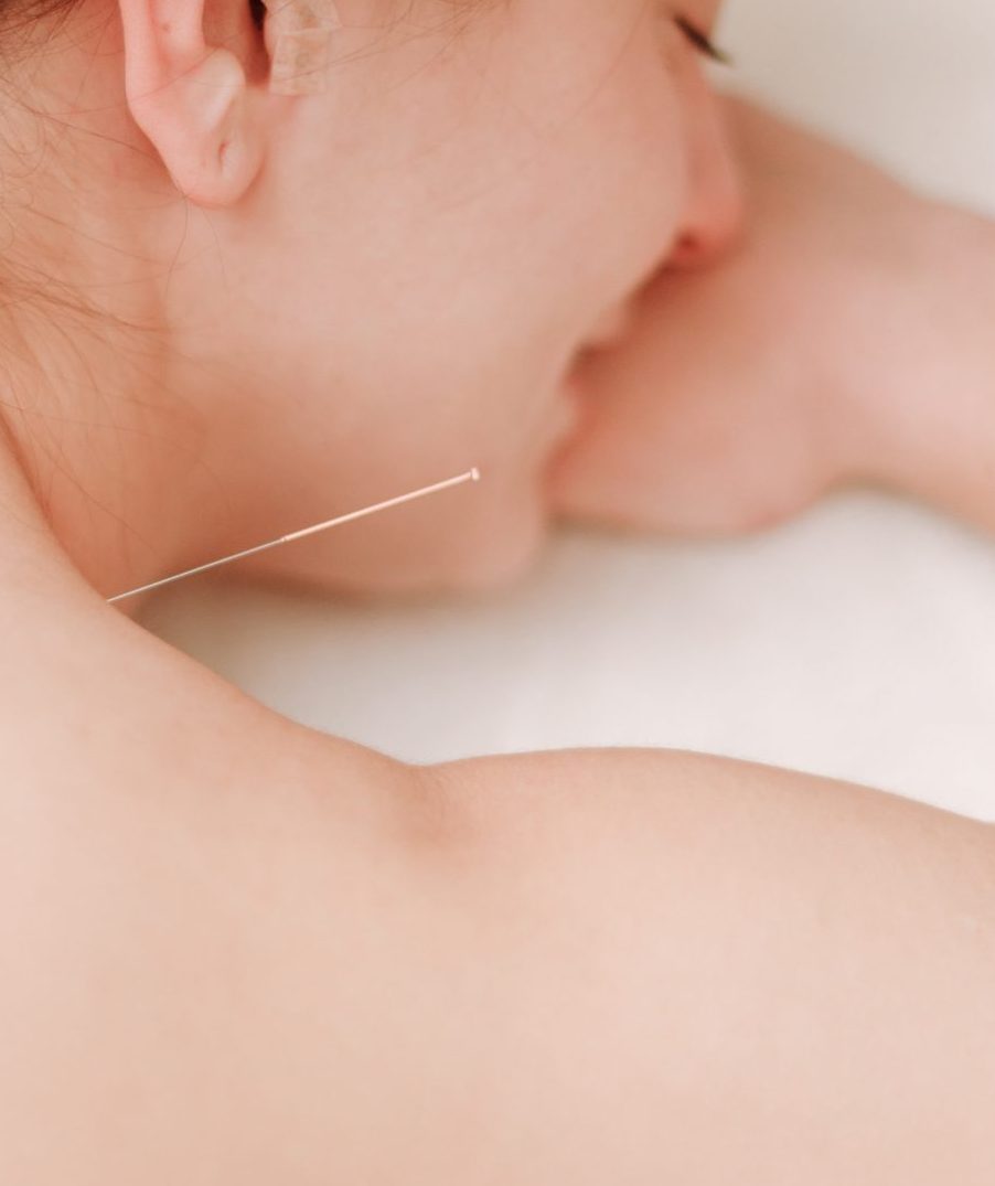 Acupuntura facial