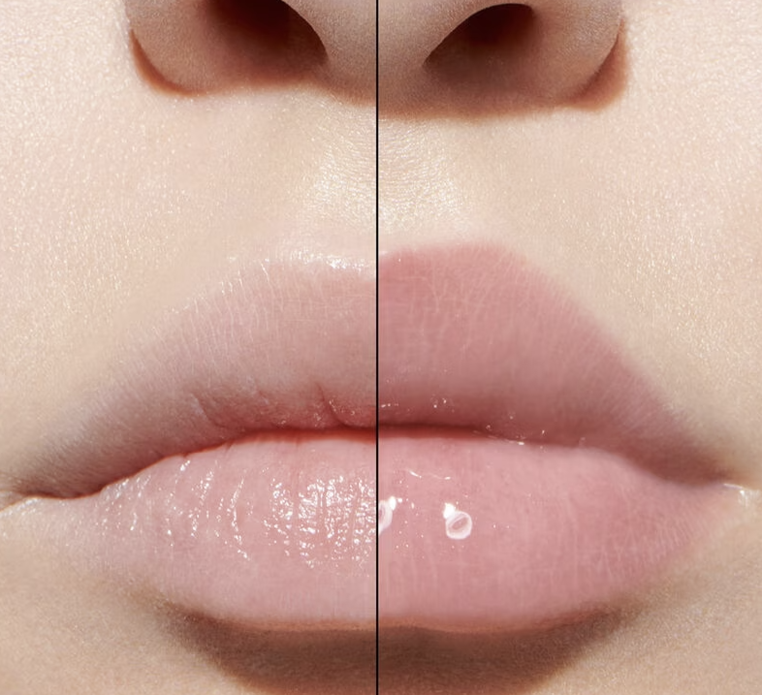 Labios voluminosos sin &aacute;cido hialur&oacute;nico