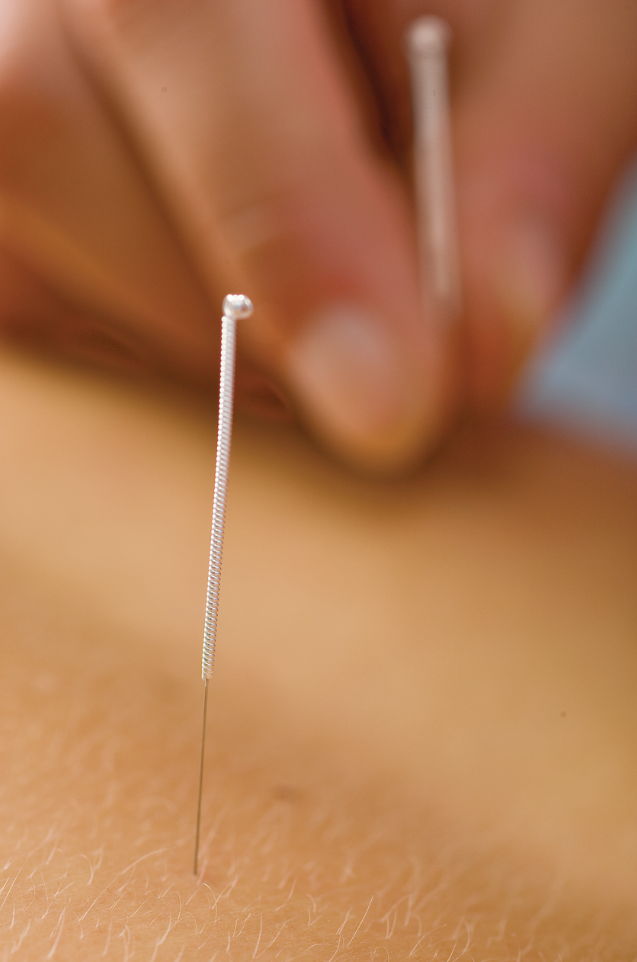 Acupuntura