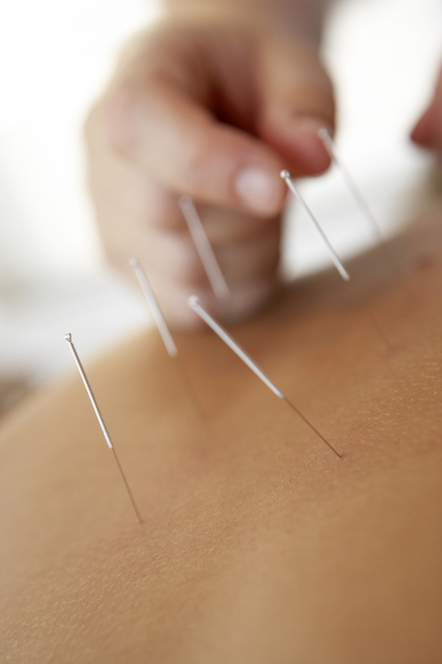 Acupuntura