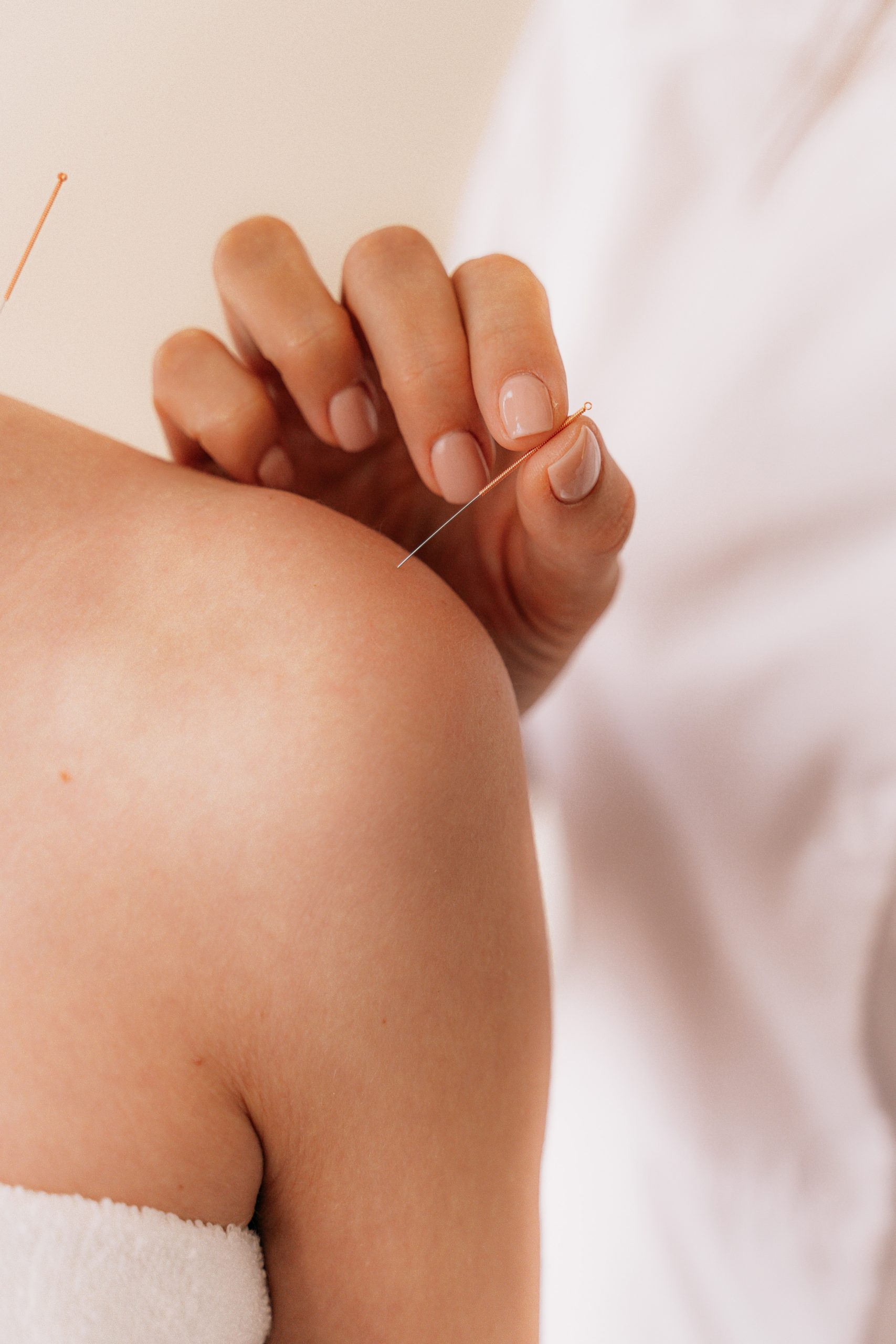 Acupuntura