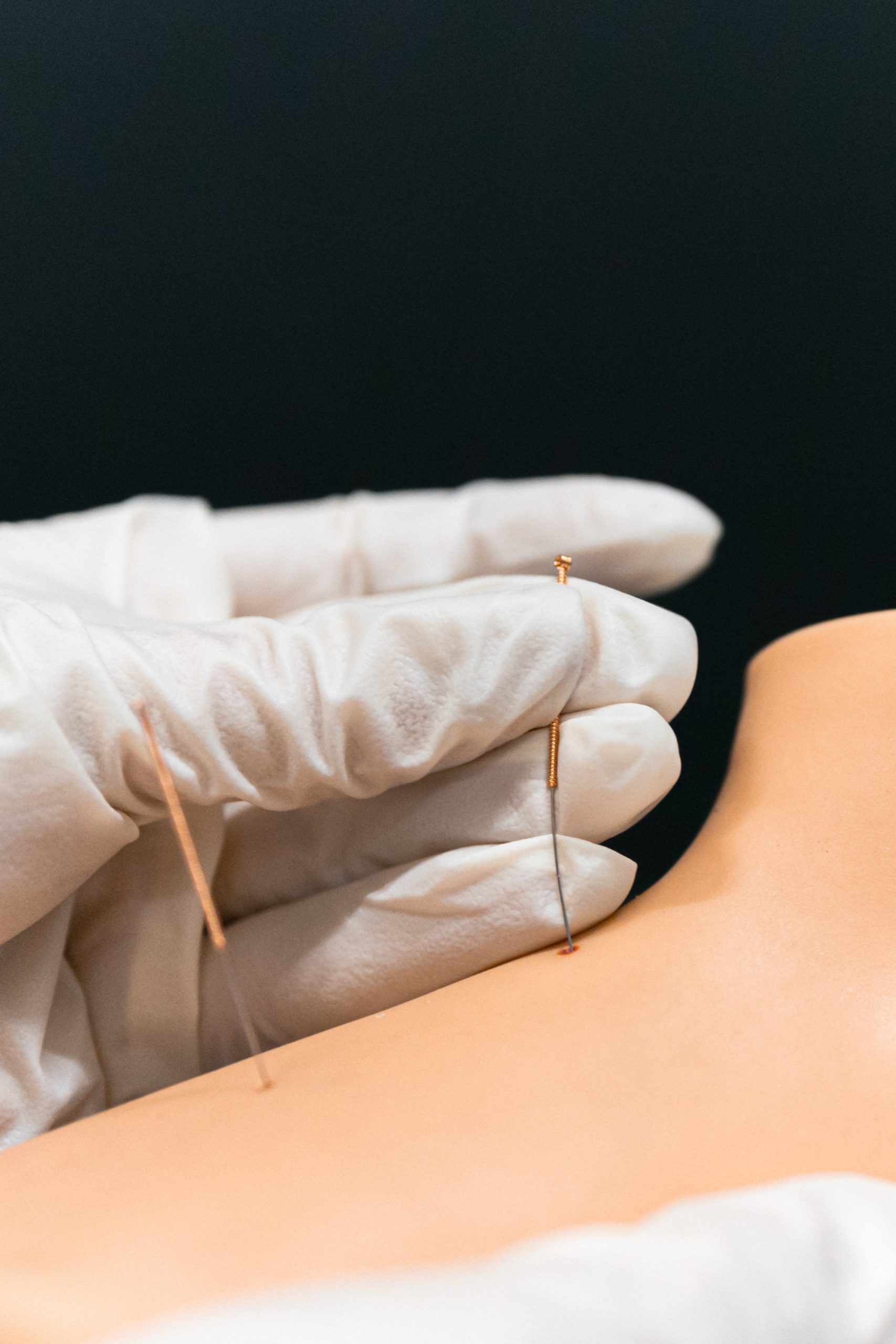 Acupuntura