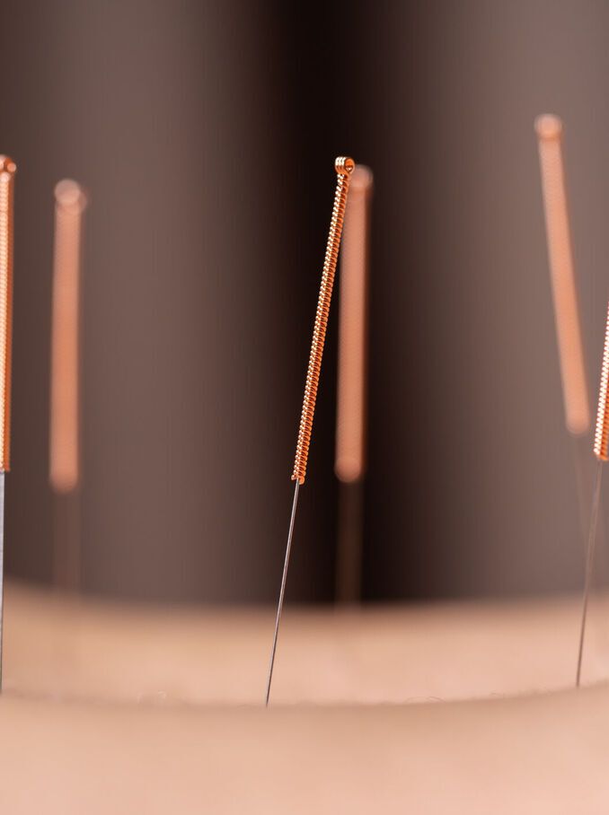 Acupuntura