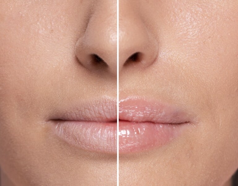 Hyaluronic Lip Volumiser