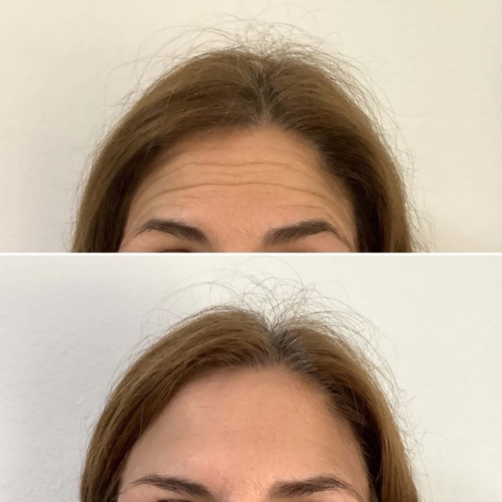 Tratamiento neuromoduladores, botox
