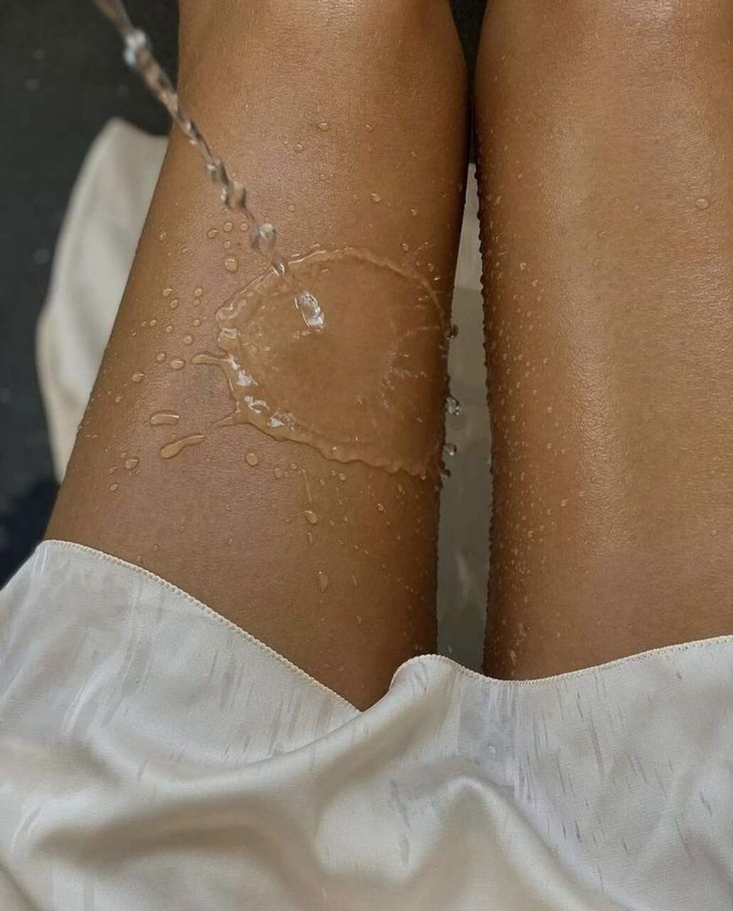 psoriasis