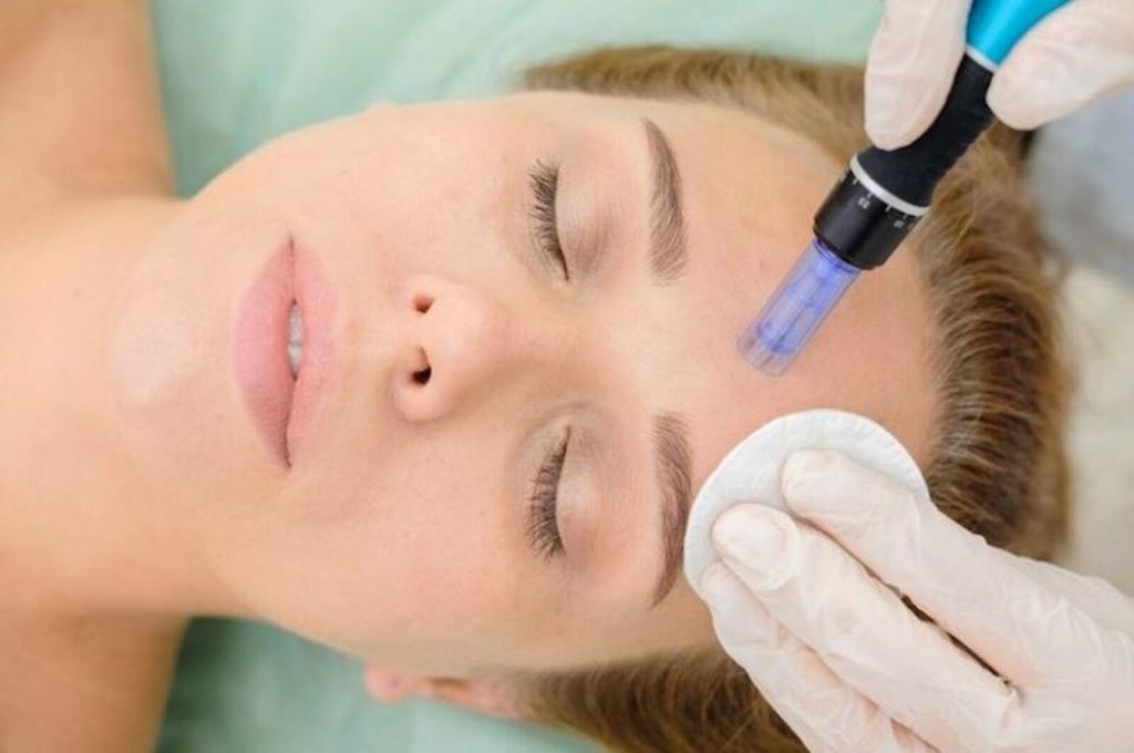 Tratamiento con dermapen para mejorar el col&aacute;geno