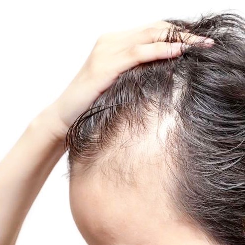 Dr. Victor Salagaray, pelo, alopecia, cabello, tricolog&iacute;a