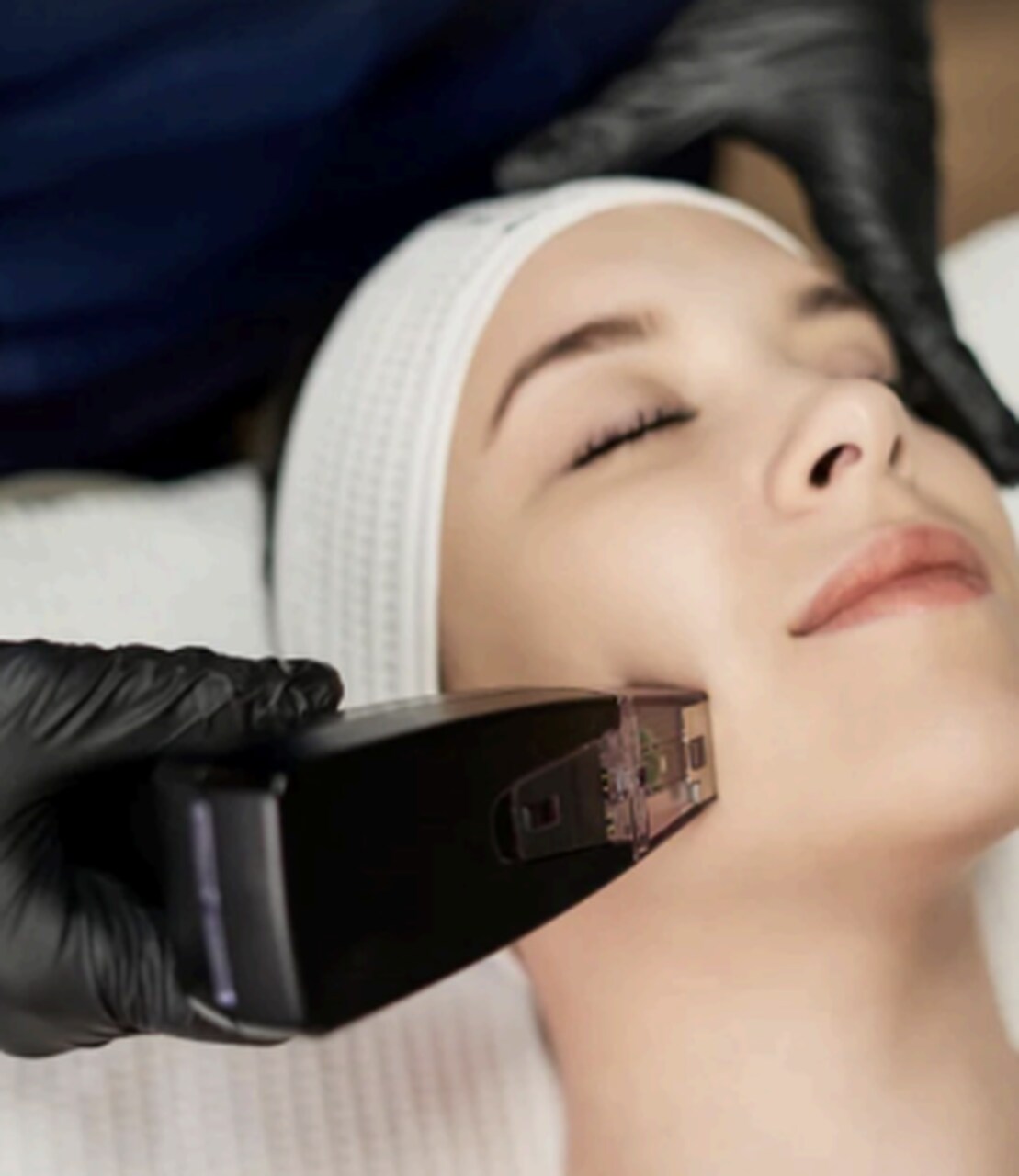 tratamiento flacidez facial laser