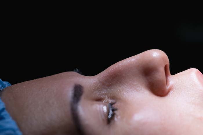 Rinoplastia secundaria / Sensabell Plastic Surgery
